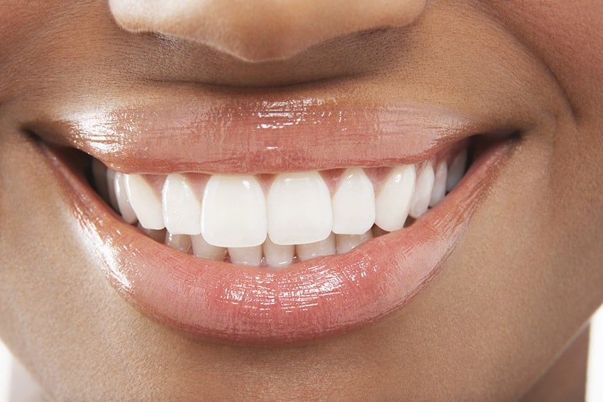 For the love of veneers